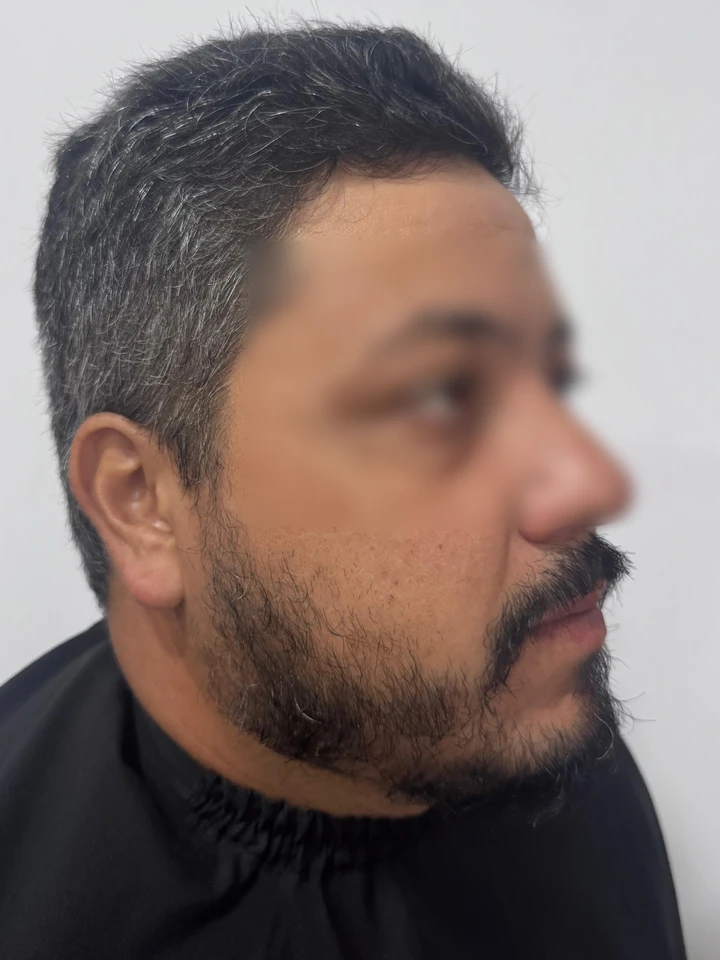 Antes Transplante de Barba FUE
