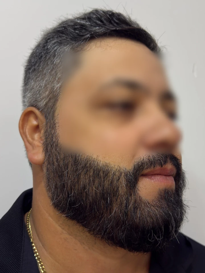 Depois Transplante de Barba FUE