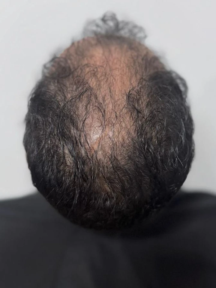 Antes Transplante FUE Coroa