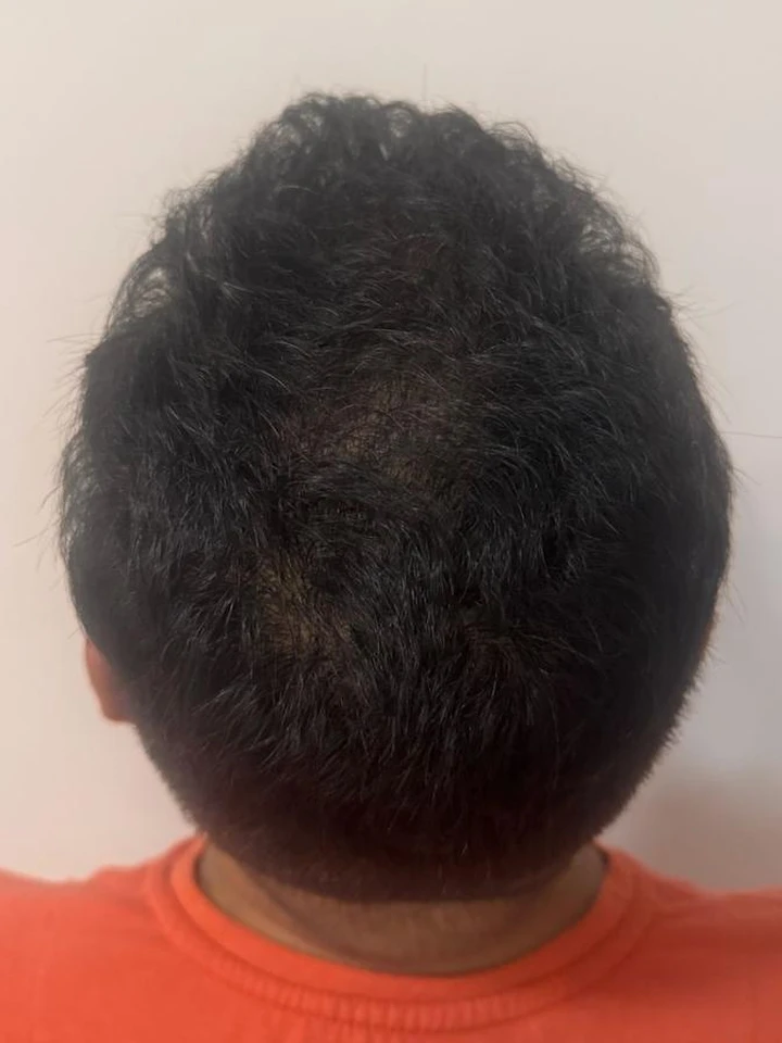 Depois Transplante FUE Coroa