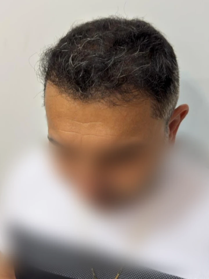Depois Transplante FUE Densidade