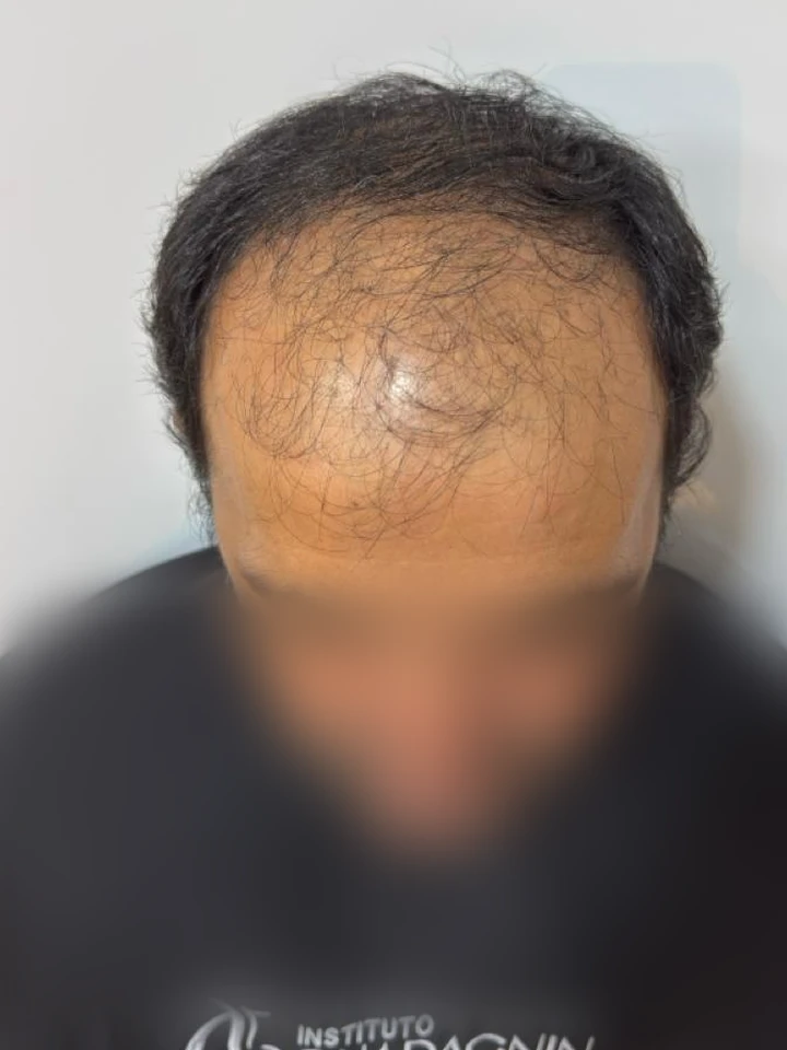 Antes Transplante FUE Frontal