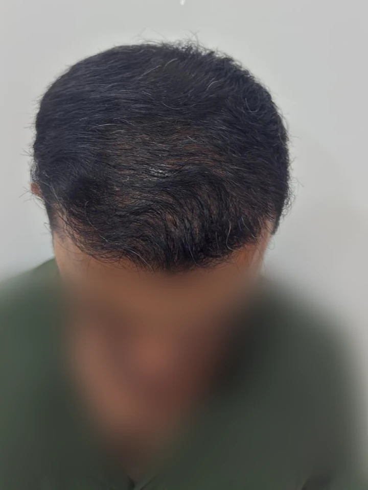 Depois Transplante FUE Frontal